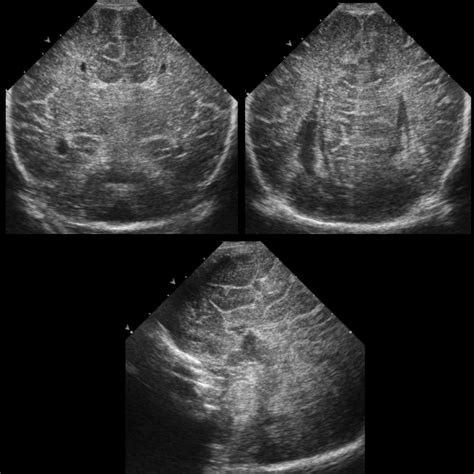 Agenesis of Corpus Callosum | Pediatric Radiology Reference Article | Pediatric Imaging ...