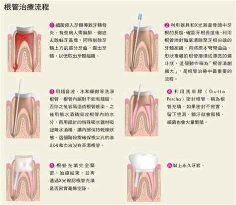 牙髓炎是什麼？一次了解牙髓炎症狀、治療以及如何預防 - 康健知識庫