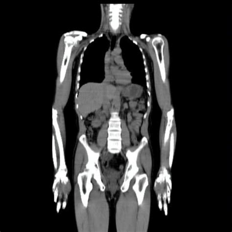Image result for Effect CT Scan