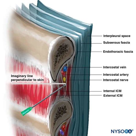 Intercostal Nerve Block
