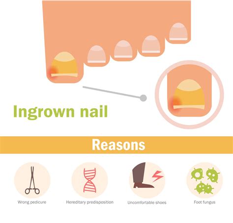 Ingrown Nail Treatment Options: At-Home Care & Lasting Podiatry Remedies | Nail Ingrown