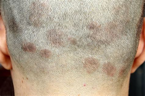 Brote de tiña: infección en el cuero cabelludo que prolifera en España