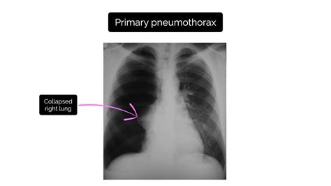 Right Pneumothorax X Ray