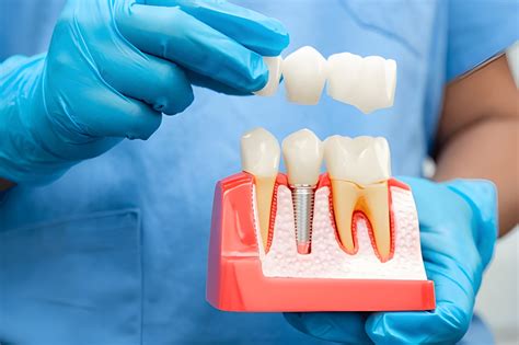 How Long Do Dental Implants Last? Key Factors Explained