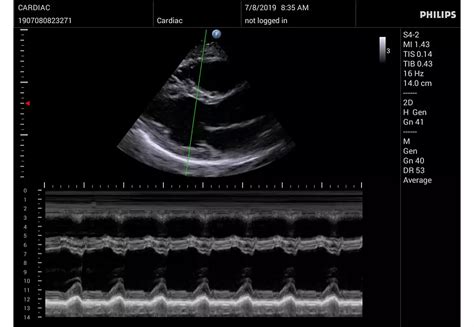 Philips - InnoSight compact ultrasound system