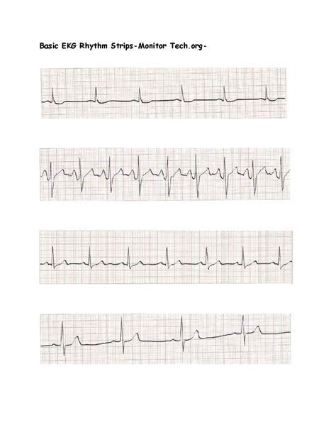 Image result for Synchronized Cardioversion EKG Strips Practice