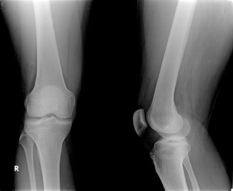 Osgood Schlatter Syndrome