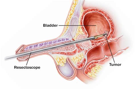Transurethral Resection Of The Prostate Provides More