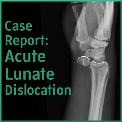 Image result for Lunate Dislocation Reduction