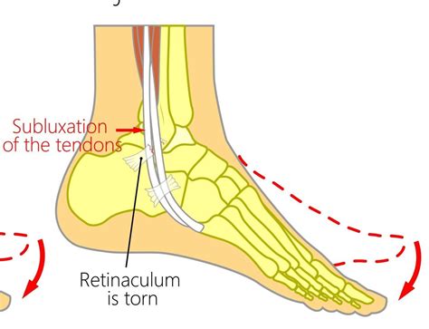 Peroneal Tendon Sublaxation - Physioflow PT | Physical Therapy ...
