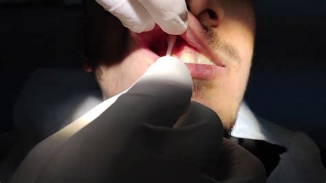 Infiltration Anesthesia Dental Lower 的图像结果
