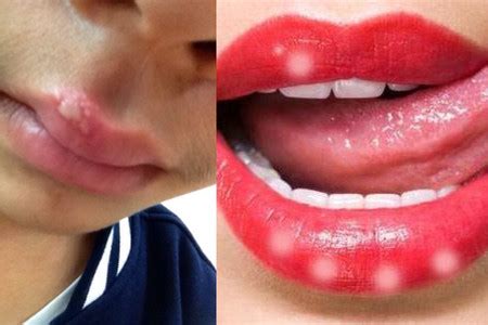 【图】为什么唇部有白色颗粒 该如何治疗_唇部有白色颗粒_伊秀美容网|yxlady.com