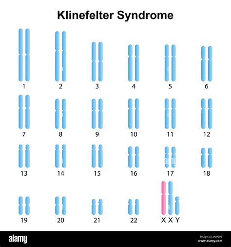 Mosaic Klinefelter Syndrome