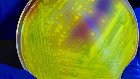 Metagenomics Saves Woman's Sight In UK—Is It The Gamechanger In ...