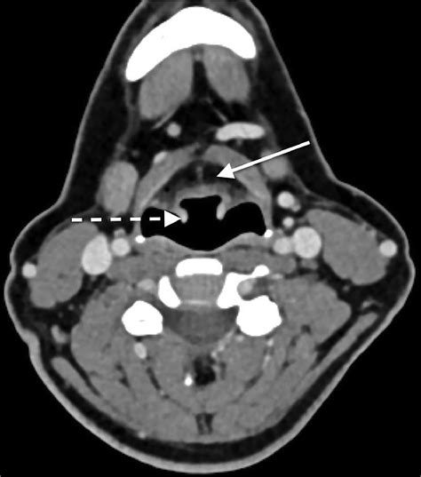 Imaging for larynx cancer assessment - Operative Techniques in Otolaryngology-Head and Neck Surgery
