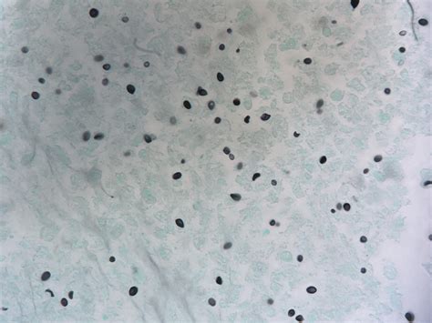 Hordes of Histo! Necrotic lymph node granuloma teeming with tons of Histoplasma capsulatum. A ...