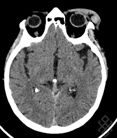 Image result for Scanner Cerebral Avec Injection Diode