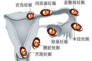 宫外孕症状早期