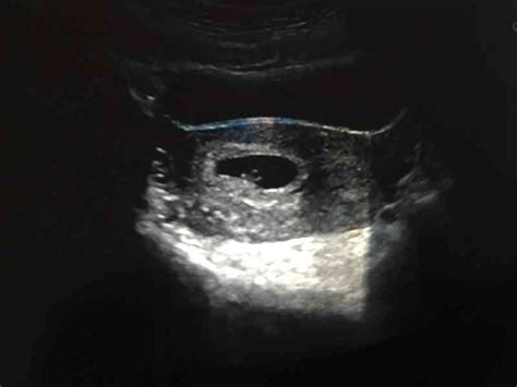 孕囊大小与孕周对照表/公式 - 准确看出胎儿发育情况 - 孕小帮