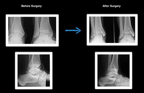 Medial Malleolar Fractures - Robert Sheinberg, DPM | Weston, FL Podiatrist