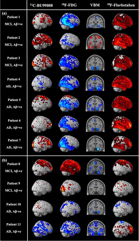 Statistical Parametric Mapping 的图像结果
