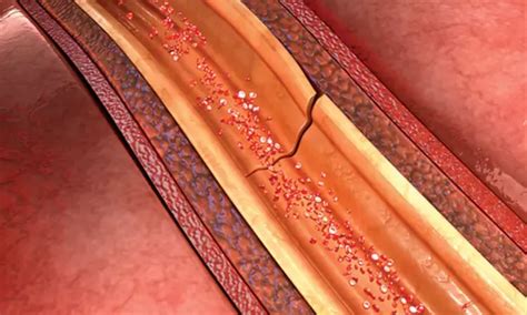 High SCAD polygenic risk score strongly associates with familial SCAD risk
