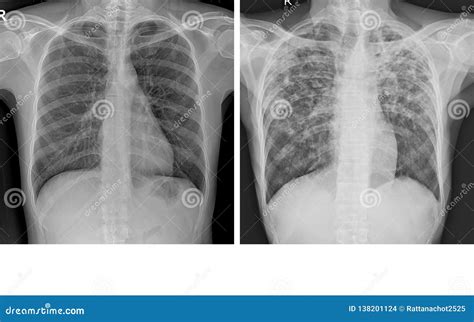 Chest X Ray Tb Vs Normal