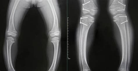 Sukha Rog Rickets in Children Causes Symptoms Treatment in Hindi ...