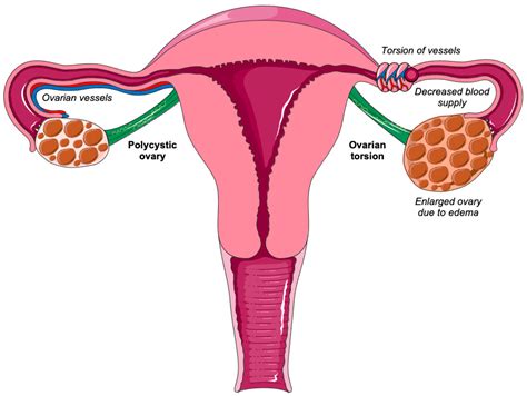 Ovarian Torsion in Polycystic Ovary Syndrome: A Potential Threat?
