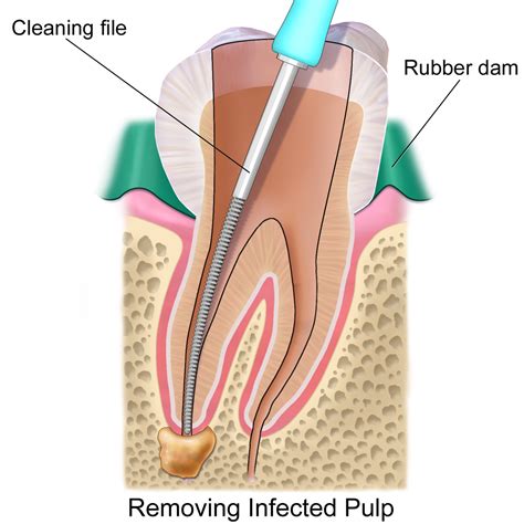 Root Canal Therapy at Roy | Lakeview Dental