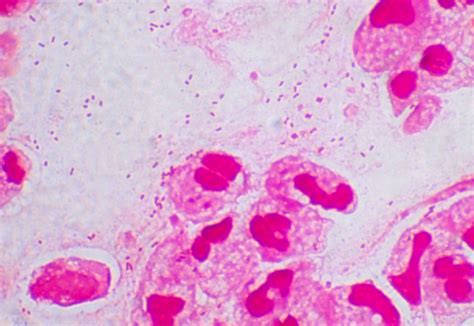 Heamophilus influenzae 〔インフルエンザ桿菌〕 | グラム染色: Gram Stain