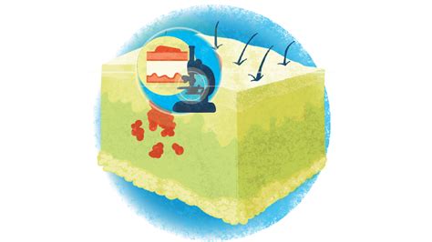 For Your Patients: What to Know about Treating Early-Stage Melanoma ...