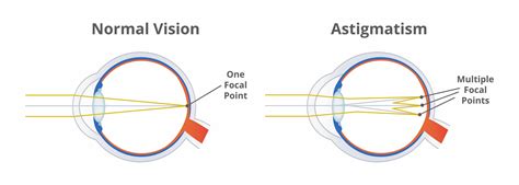 Astigmatism Treatment in Turkey | Free Online Consultation
