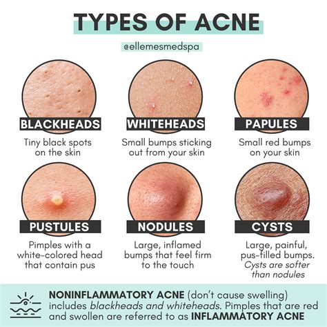 Acne Nodule Vs Cyst