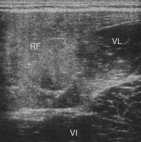 Sonography of Lower Limb Muscle Injury | AJR