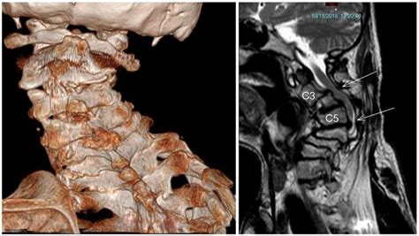 3D Printing in Surgical Planning and Intra-Operative Assistance: A Case ...