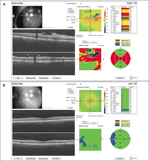 Vitreoretinal Adverse Effects Associated With Oxymetazoline Drops for Blepharoptosis | Retinal ...