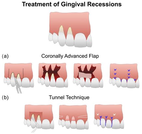 Gingival Flap Dental Code at Patsy Carranza blog
