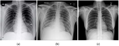 Chest X Ray Bronchitis Vs Pneumonia