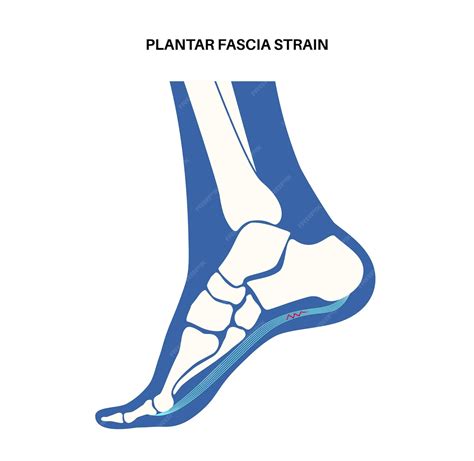 Premium Vector | Plantar fascia strain anatomical poster Tear of the soft tissue under the arch ...