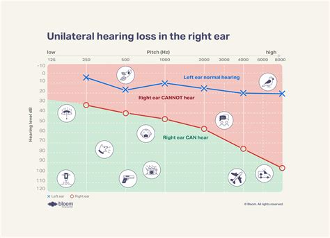 Hearing loss In one ear (left/right) - The complete guide