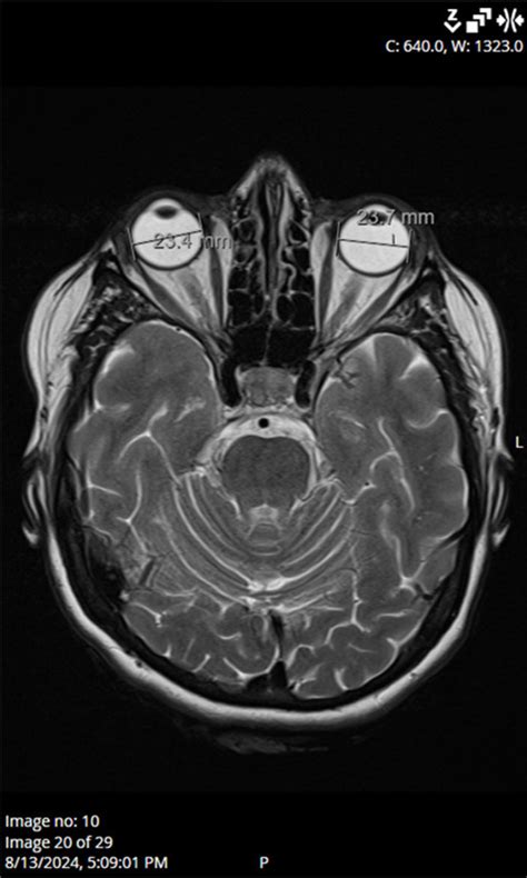 Is Semaglutide Linked to NAION? A Case Report on a Rare Ocular Complication