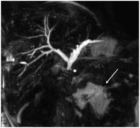 Percutaneous Biliary Rendez-Vous to Treat Complete Hepatic-Jejunal ...