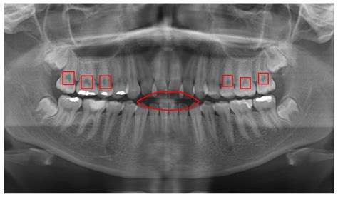 Detection of Cavities from Dental Panoramic X-ray Images Using Nested U-Net Models