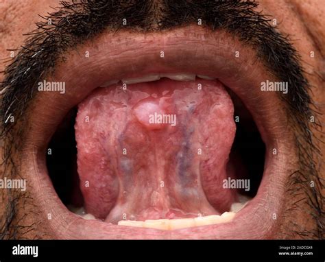 Not for use in Television Not for use in Television Mucous retention cyst. Close-up of a mucous ...