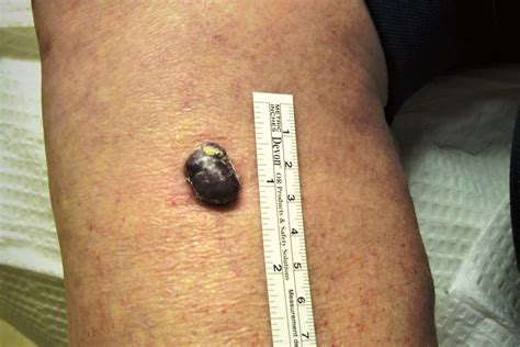 Melanoma Black Spot On Skin