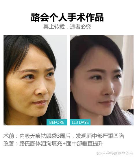 30岁瞒着家人独自来京做泪沟填充，术前术后无美颜对比，变化真的很大 - 知乎