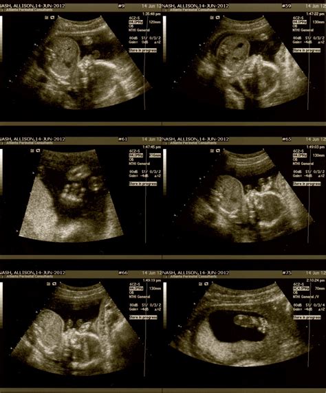 Sweet Baby Nash: 20 Week Anatomy Scan