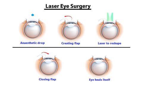 Refractive Eye Surgery