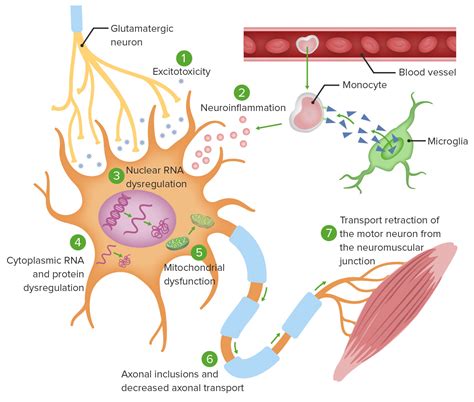 Esclerosis Lateral Amiotrófica | Concise Medical Knowledge